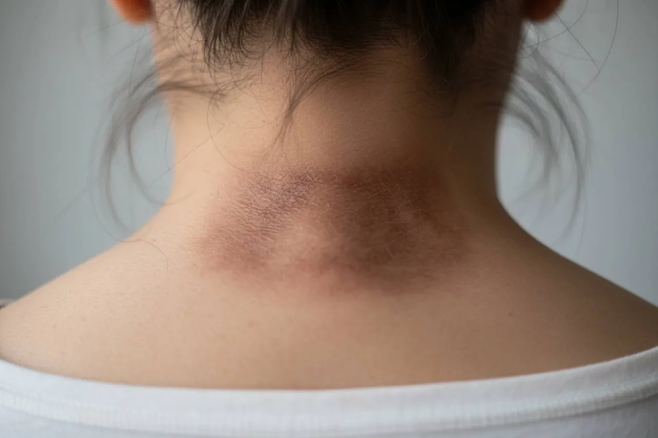 Oltre il neo: altri segnali cutanei da non sottovalutare